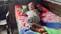 bocah derita hidrosifalus